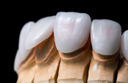 Ceramic Dental Restorations in HSR Layout