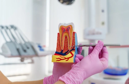 root canal