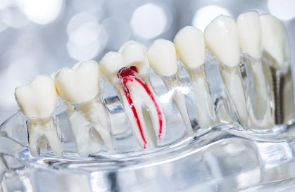 Painless Root Canal Marathahalli